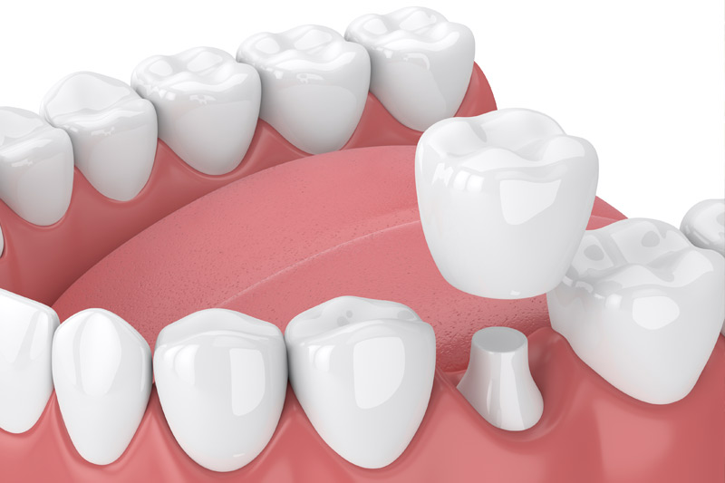 Dental Crowns in Yorktown Heights