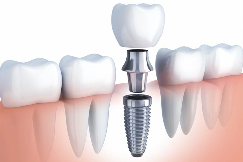 Implants Dentist in Yorktown Heights