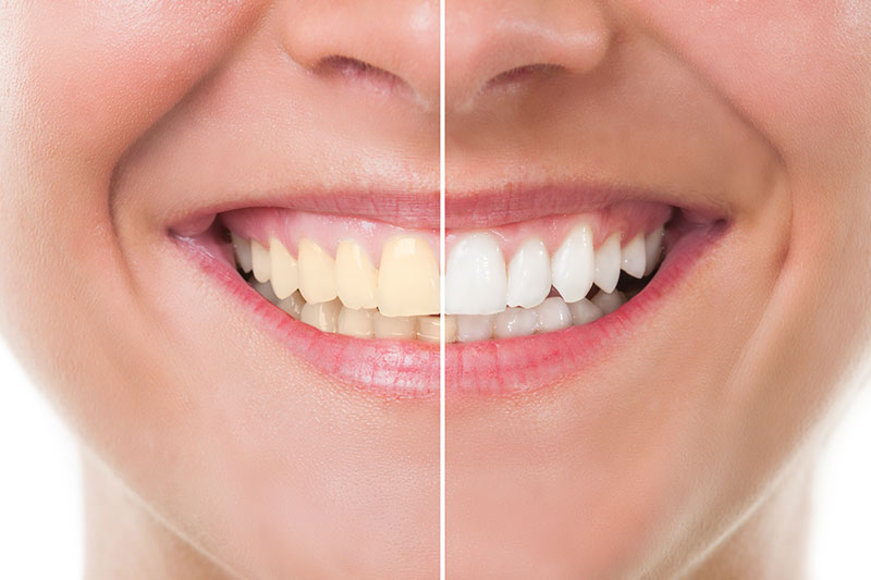 Teeth Whitening in Yorktown Heights